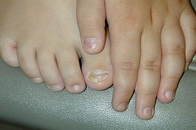 onychomycosis396x264