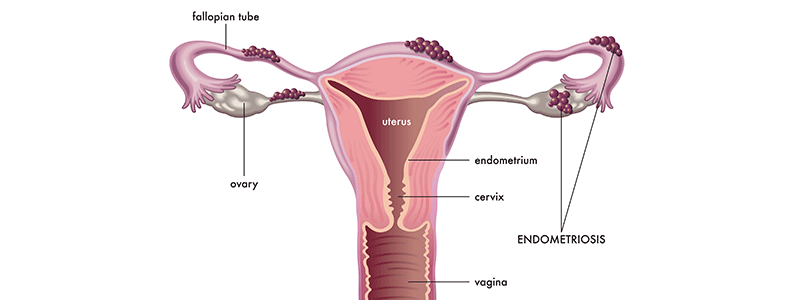 Shutterstock_1954674190_Endometriosis-800x300
