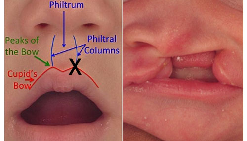 formation+of+the+lip_unilateral_cleft