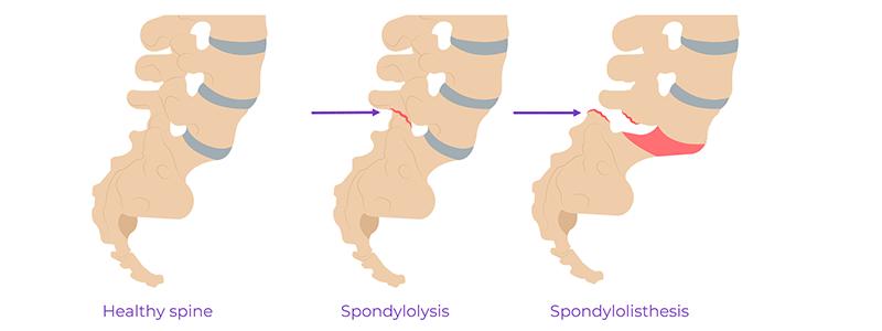 Shutterstock_1835855416-Spondylolysis-and-Spondylolisthesis-800x300