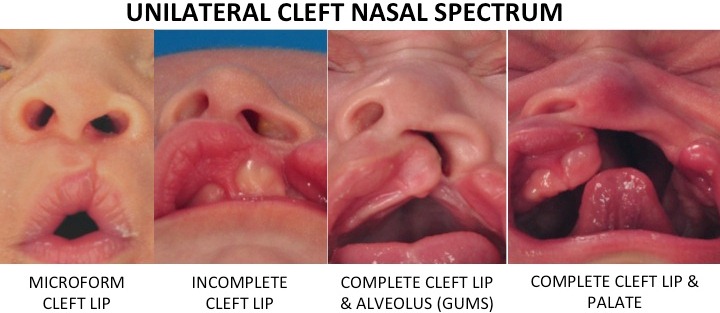 Unilateral-cleft-Nasal-Spectrum