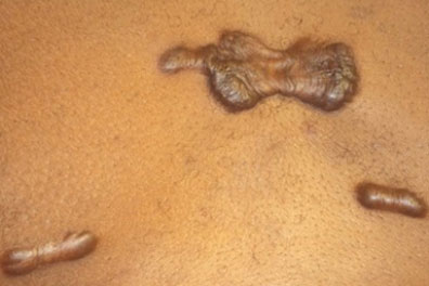 keloid2