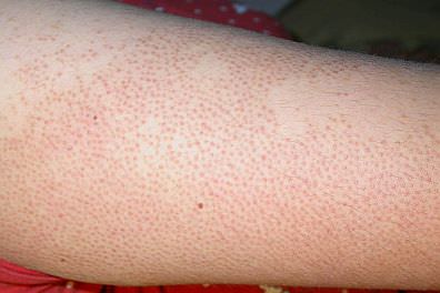 Keratosis_pilaris_tn_mini