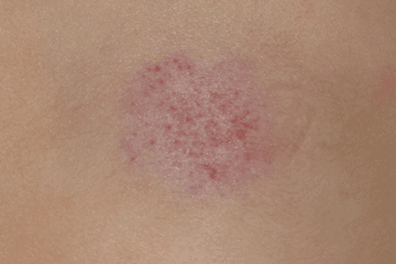 Rapidly-involuting-congenital-hemangioma-(RICH) 396x264