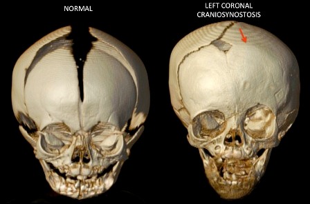Unilateral-Coronal-Synostosis-Front