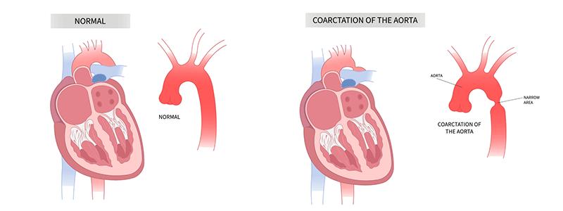 Shutterstock_2216232895-Coarctation-of-the-Aorta-800x300