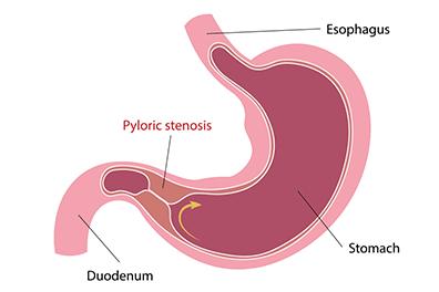 Shutterstock_2287986235-Pyloric-stenosis-396x264