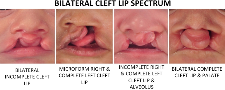 BilateralCleftLipSpectrum