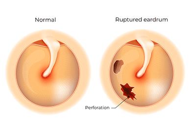 Shutterstock_1104680744-Ruptured-Eardrum-396x264