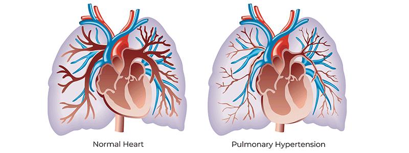 Shutterstock_2008561808-Pulmonary-Hypertension-800x300