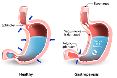 Shutterstock_394651381_Gastroparesis-396x264