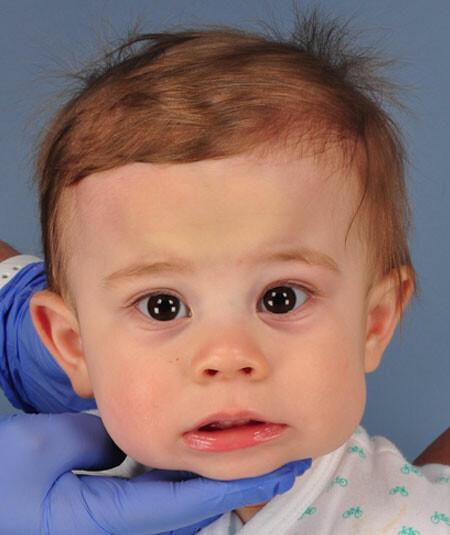 Dexter Osborne (5/20/2017) had metopic craniosynostosis and underwent strip craniectomy surgery using limited incision technique. 4 additional photos are used from different angles.