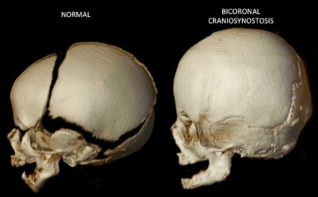 Bilateral+Coronal+Synostosis+Side