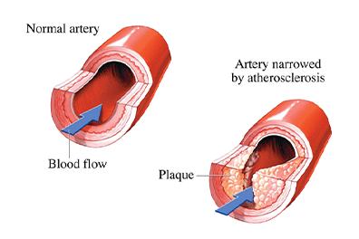 Atherosclerosis-396x264