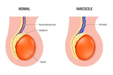 SHutterstock_2401998975-Varicocele-396x264