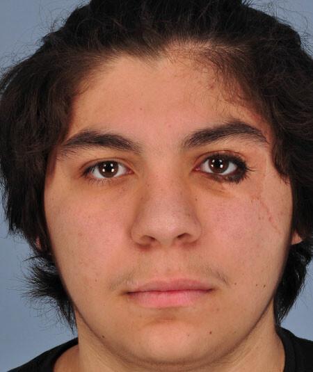 Luis Torres (DOB 4/4/2001) Luis had a substantial nevus (mole) surrounding his eye. Image before treatment. There are 3 additional images used from different angles.