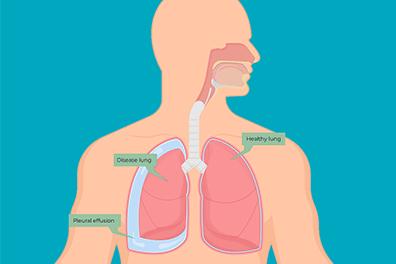 Shutterstock_1704016279-Pleural-Effusion
