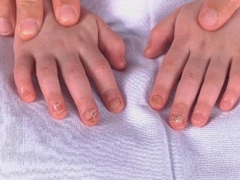 Naildystrophy2_mini