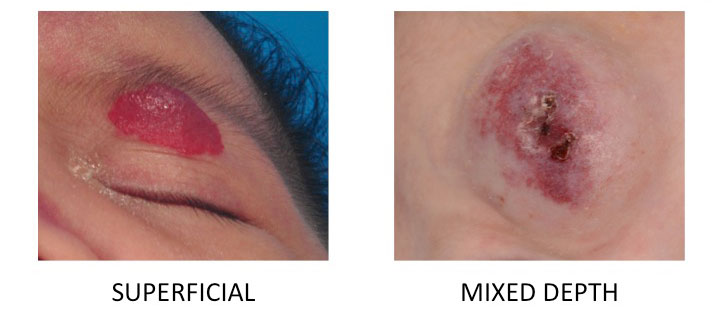 superficial-hemangioma-and-mixed-depth-hemangioma