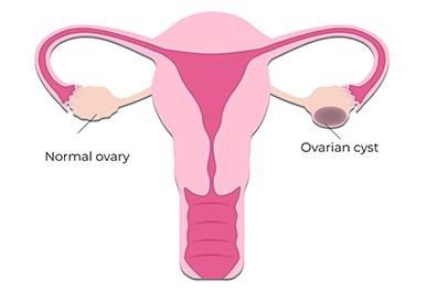 Shutterstock_1646326420-Ovarian-Cyst-396x264