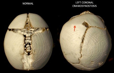 Unilateral+Coronal+Synostosis+Top