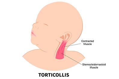Shutterstock_2387631353-Torticollis-396x264