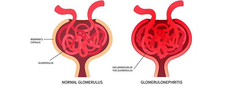 Shutterstock_2391990189-Glomerulonephritis-800x300