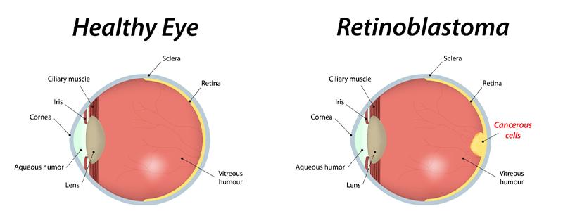 Shutterstock_209131783-Retinoblastoma-800x300