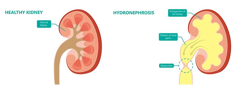 Shutterstock_1760032427-Hydronephrosis