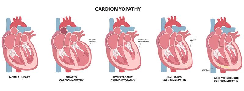 Shutterstock_2150215157-Cardiomyopathy-800x300