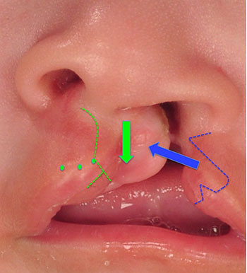 Unilateral+Lip+Repair+Schematic
