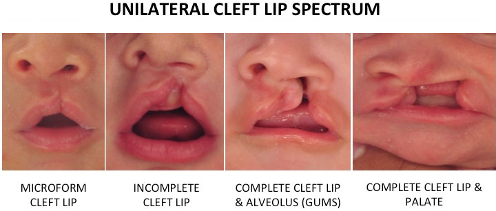 Unilateral+Cleft+Lip+Spectrum2