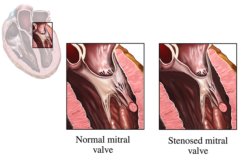 mitral-stenosis-si55551208