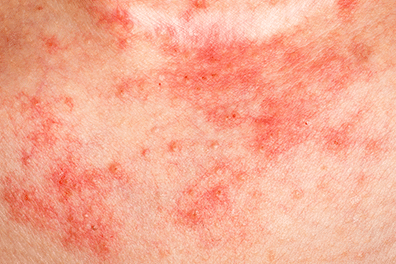 shutterstock_2354568781_Eczema-396x264