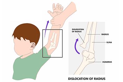 Shutterstock_2162925921-Nursemaids-Elbow-396x264