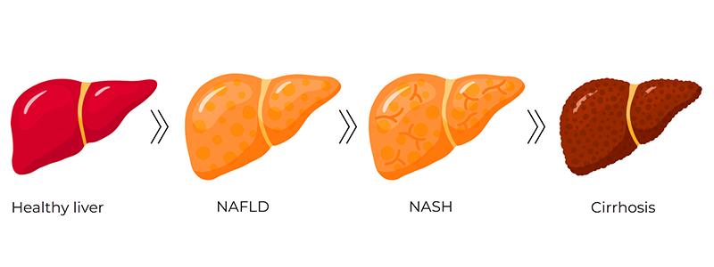 Shutterstock_1168461886-NAFLD-NASH-800x300