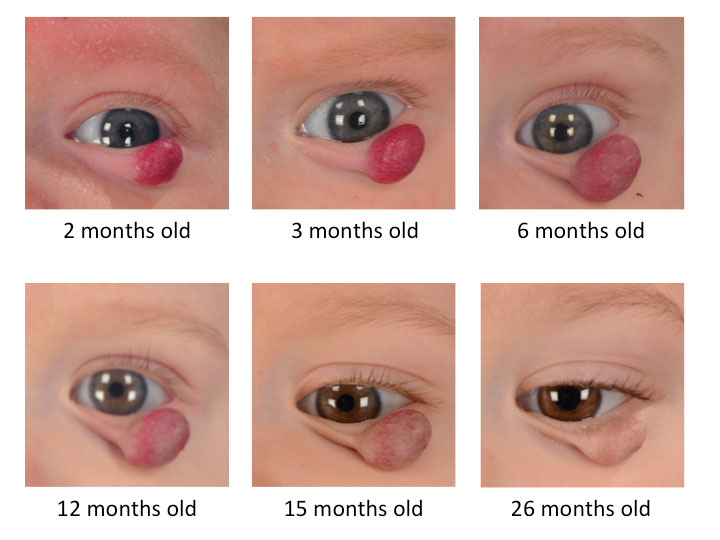 Eye-Hemangioma-2-26mo