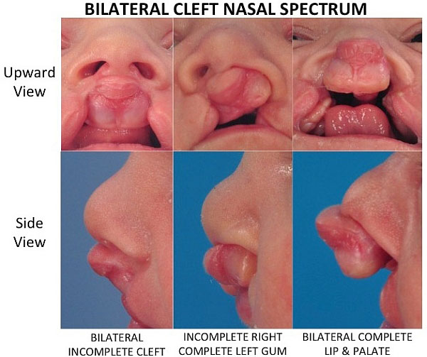 BilateralCleftNasalSpectrum